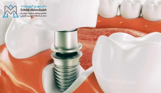 خدمات ایمپلنت دندانی