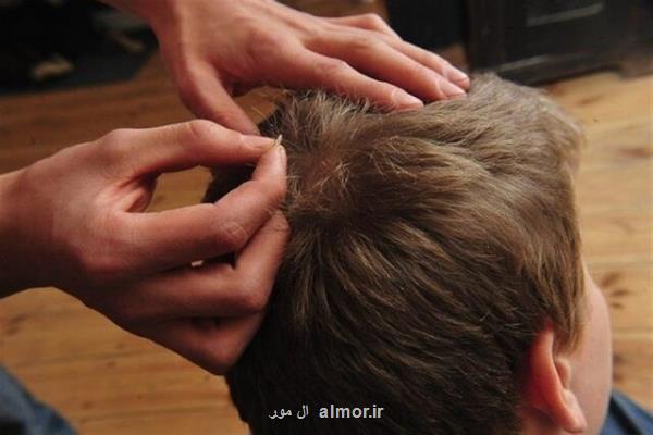 شپش سر و درمان های رایج آن، چگونه شپش منتقل می شود؟